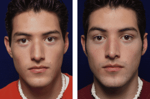 male-rhinoplasty-adult-before-and-after