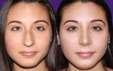 female before and after nose job results