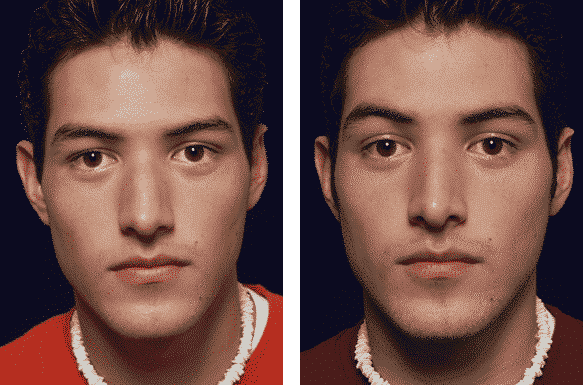 Kim Patrick Murray Rhinoplasty Cost Guide To Analyzing Rhinoplasty Before + After Photos - Kim Patrick