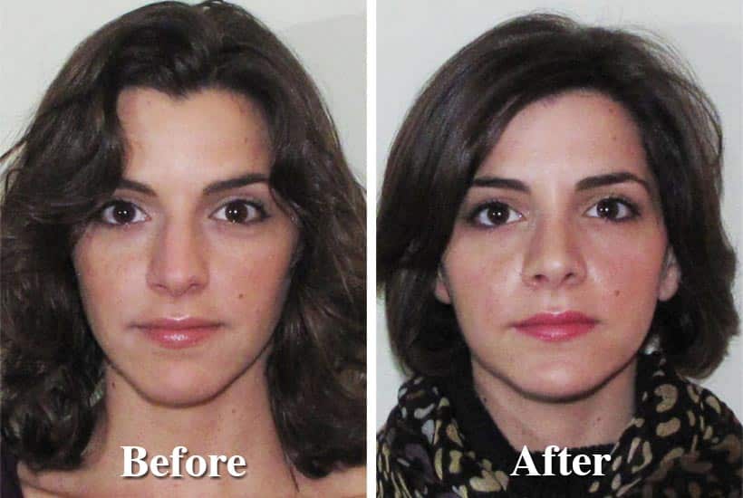 rhinoplasty-before-after female pictures