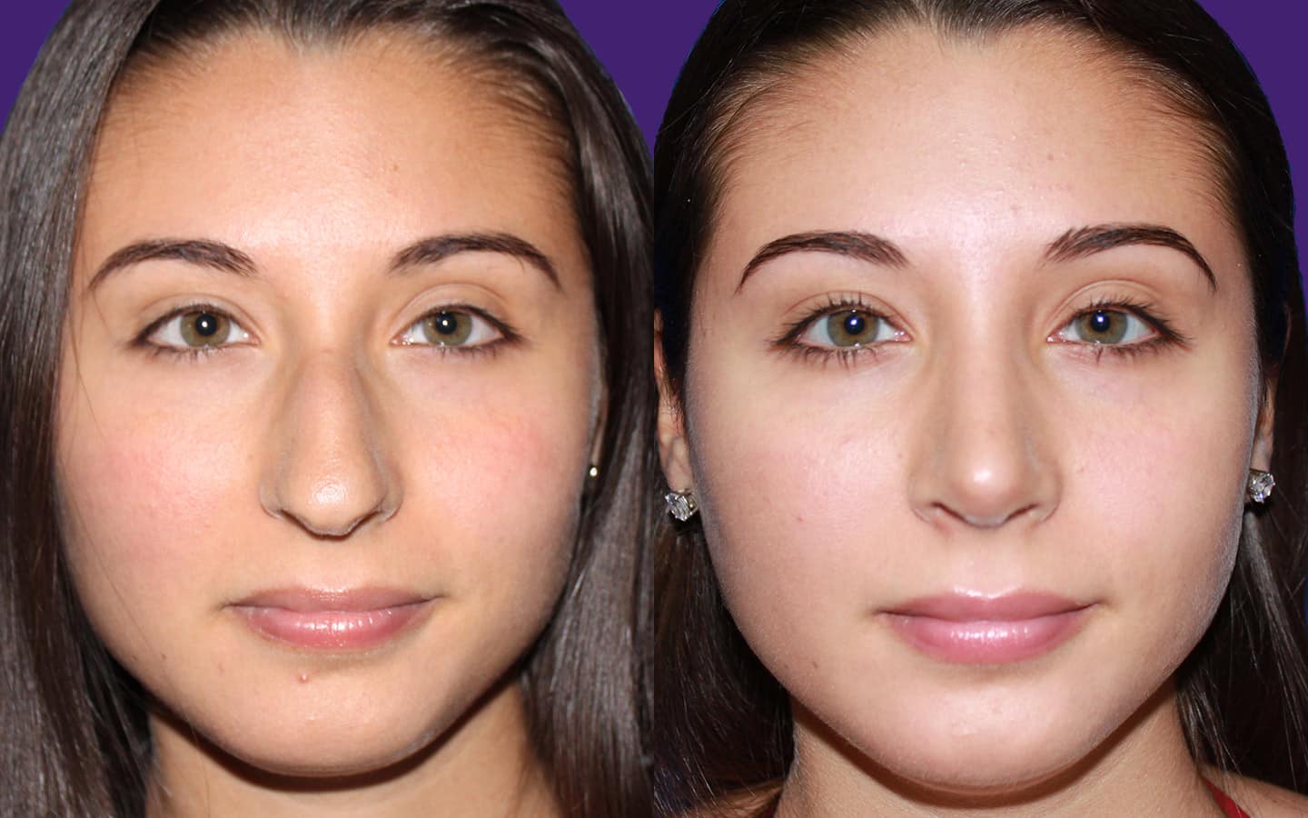 Kim Patrick Murray Rhinoplasty Cost Guide To Analyzing Rhinoplasty Before + After Photos - Kim Patrick