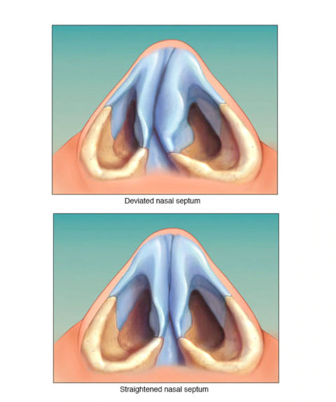 Deviated Septum surgery - Kim Patrick Murray, MD - #MURRAYNOSE